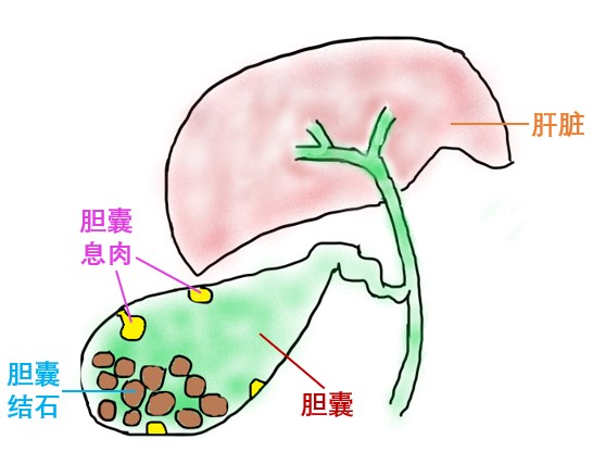 器官保留疗效好让患者绝处逢生ag旗舰厅平台内镜超级微创：(图1)