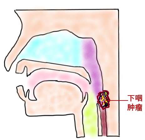 器官保留疗效好让患者绝处逢生ag旗舰厅平台内镜超级微创：(图5)