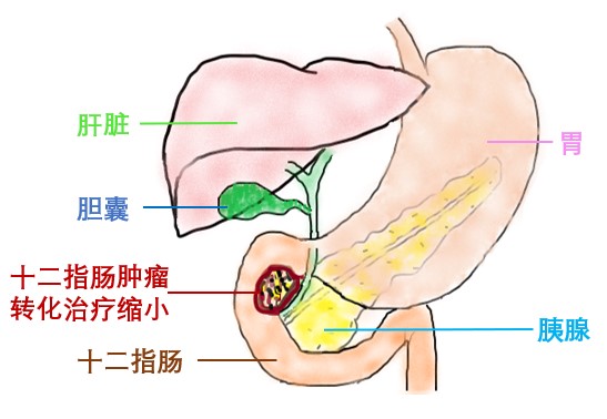 器官保留疗效好让患者绝处逢生ag旗舰厅平台内镜超级微创：(图17)