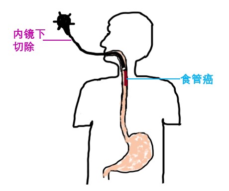 器官保留疗效好让患者绝处逢生ag旗舰厅平台内镜超级微创：(图20)