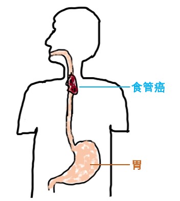 器官保留疗效好让患者绝处逢生ag旗舰厅平台内镜超级微创：(图21)