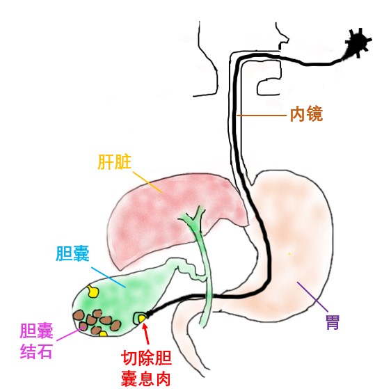 器官保留疗效好让患者绝处逢生ag旗舰厅平台内镜超级微创：(图22)