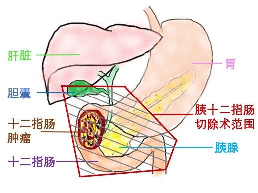 器官保留疗效好让患者绝处逢生ag旗舰厅平台内镜超级微创：(图27)